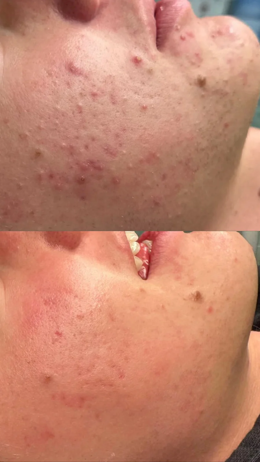 Acne Journey before and after